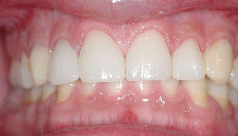Veneers-After-Image