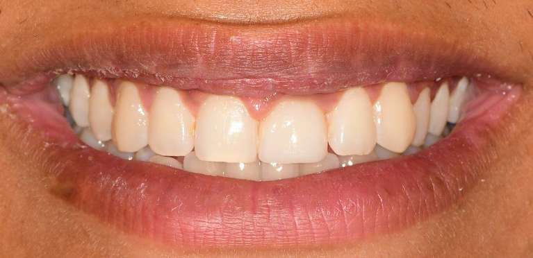 Dental-Implant-After-Image