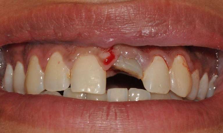 Dental-Implant-Before-Image