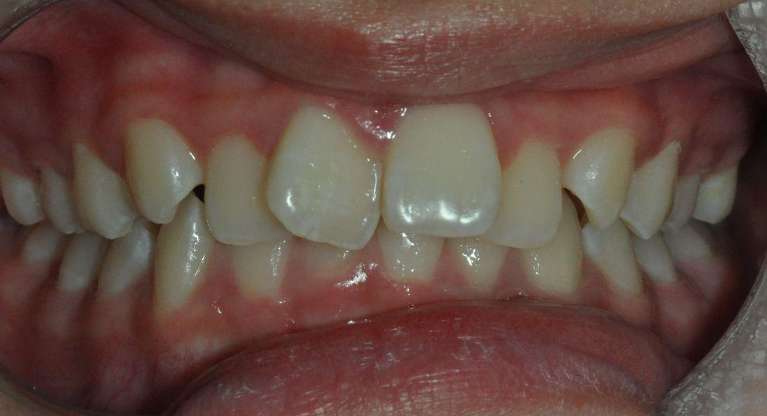 Orthodontics-Before-Image