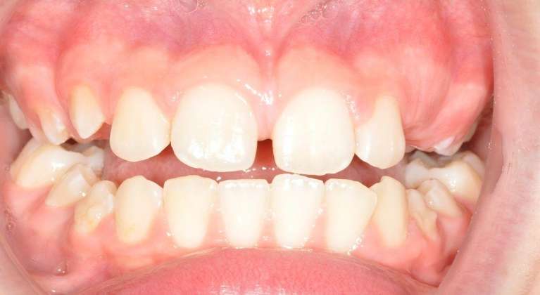 Crowns-Before-Image