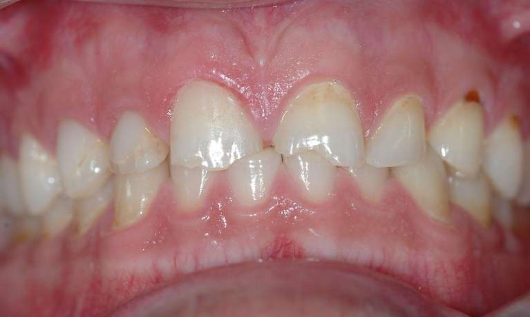 Veneers-Before-Image